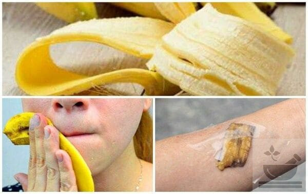 Банан от укусов насекомых